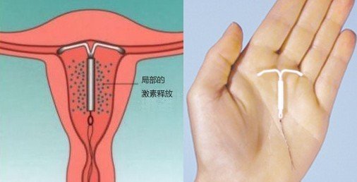 现代避孕技术革新